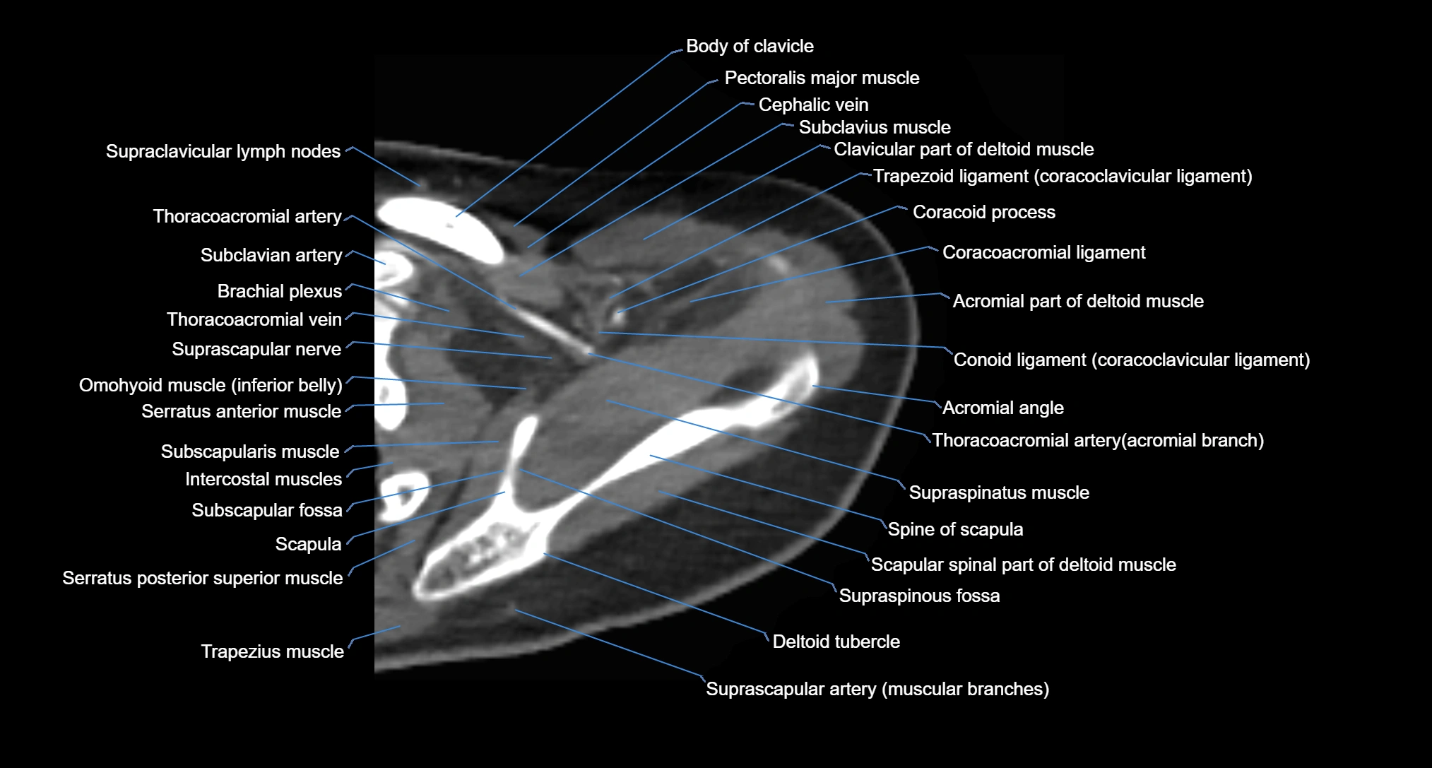 CT Shoulder axial cross sectional anatomy labelled radiology image -00020.webp